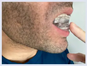 Dream Hero Mouthguard step 3