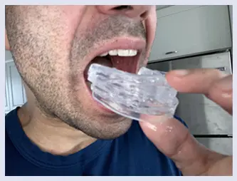 Dream Hero Mouthguard step 2